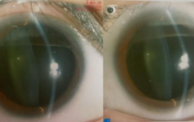 十周年 我与华厦的故事：香港患者在深圳华厦重获清晰视力